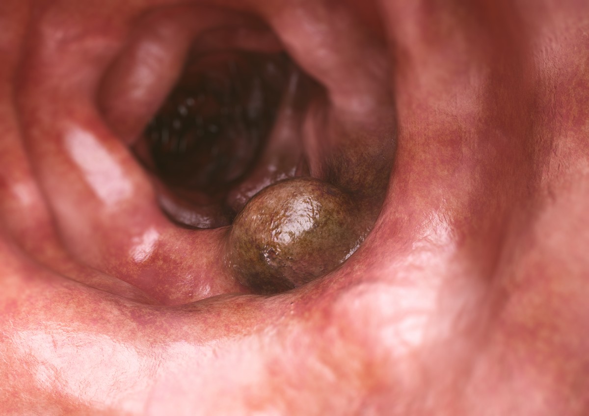 colon cancer